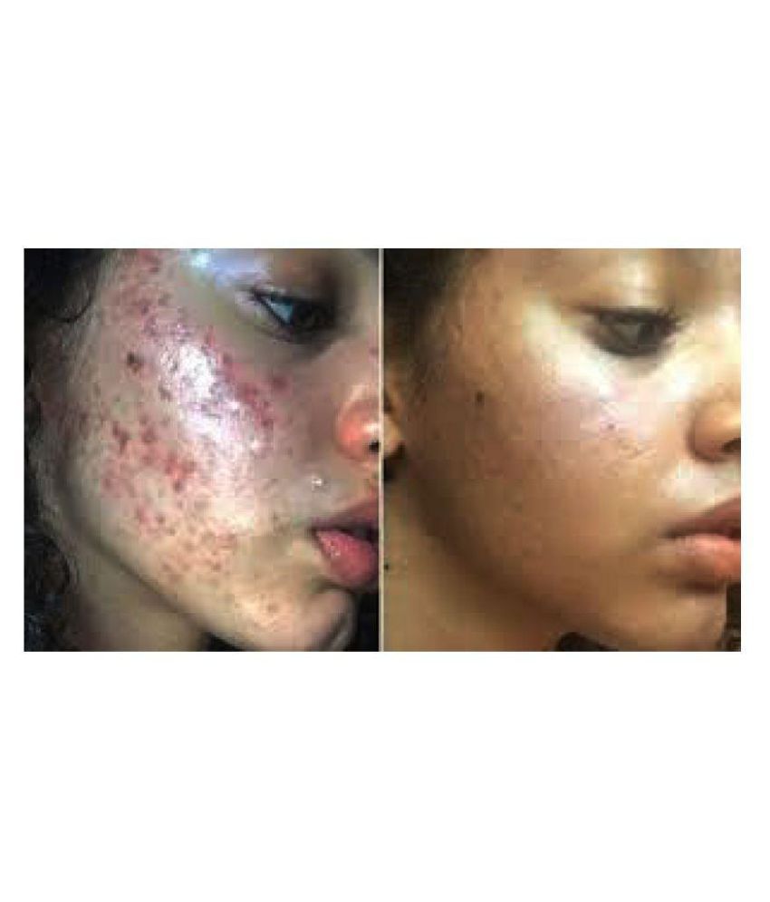facial spot removal Facial spot removal